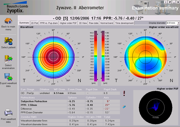 lasik nice, chirurgie refarctive nice, cataracte nice