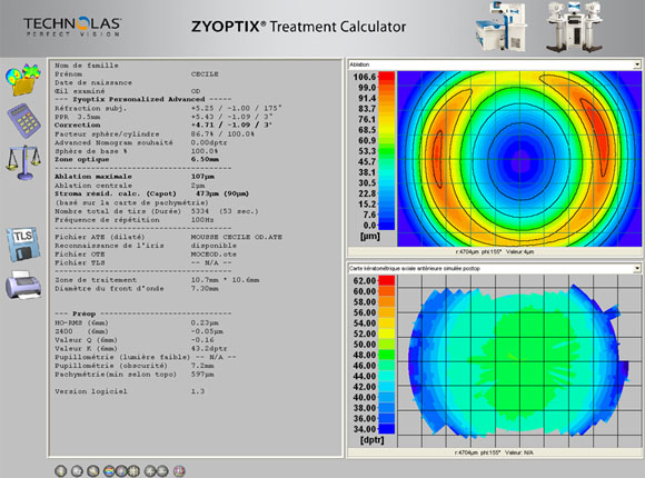 lasik nice, chirurgie refarctive nice, cataracte nice