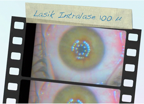 lasik nice, chirurgie refarctive nice, cataracte nice