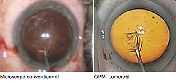 lasik nice, chirurgie refarctive nice, cataracte nice