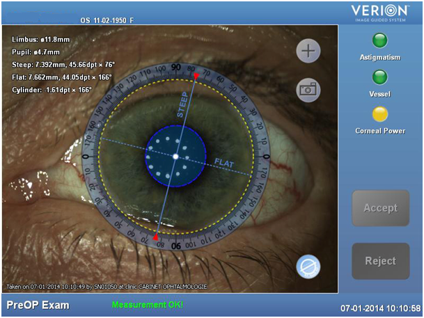 lasik nice, chirurgie refarctive nice, cataracte nice