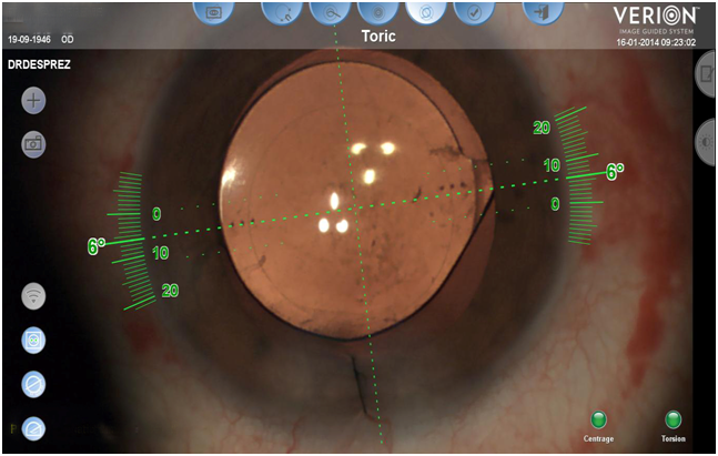 lasik nice, chirurgie refarctive nice, cataracte nice